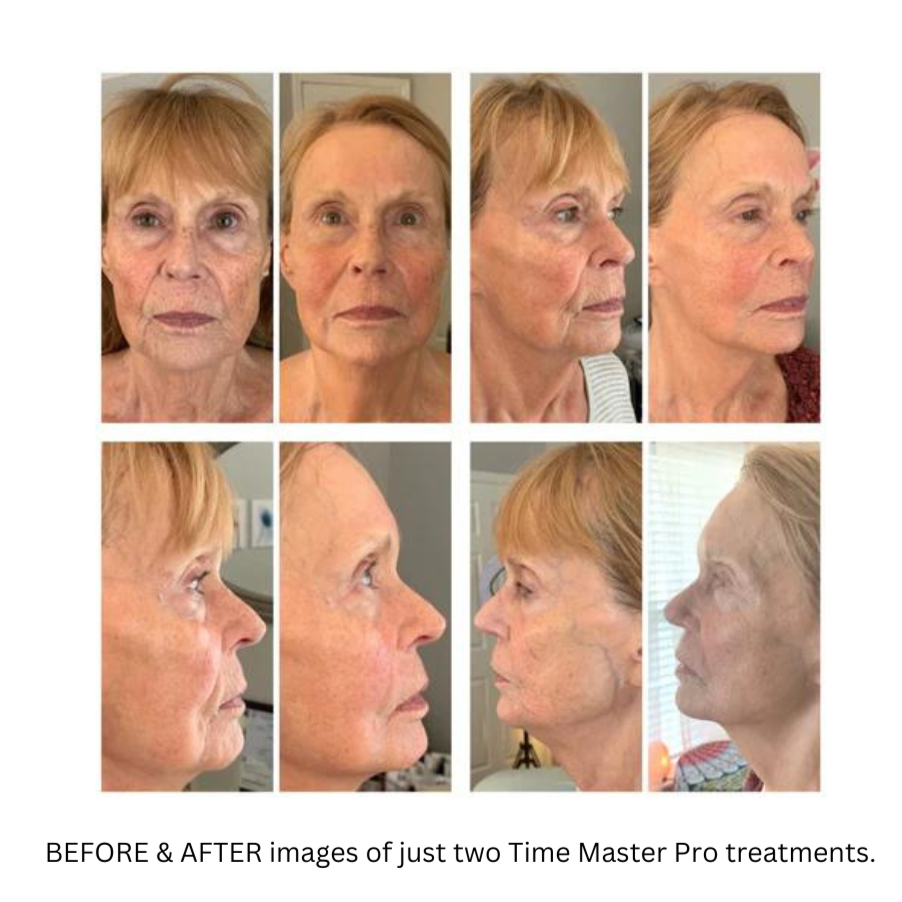The TimeMaster Pro Ultrasound + EMS with LED assists in skin tightening and wrinkle smoothing due to the plumping effects of Ultrasound