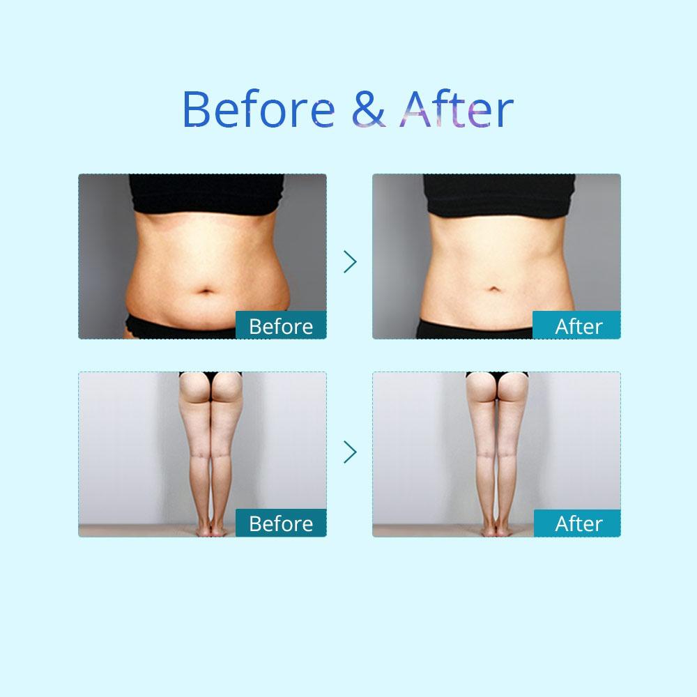 Cryo Tone Face and Body Contouring device