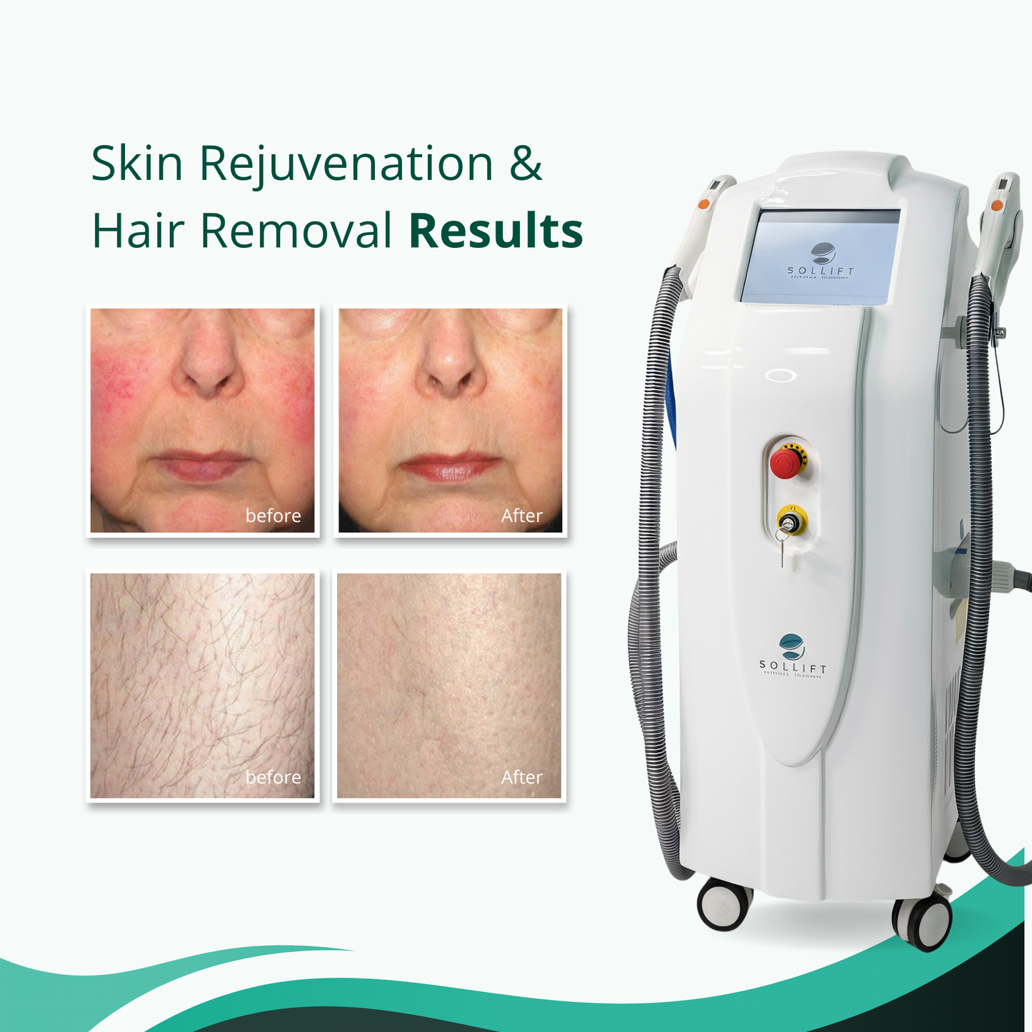 The Medi Next Advanced IPL Hair Removal and Skin Rejuvenation device (FDA-approved)