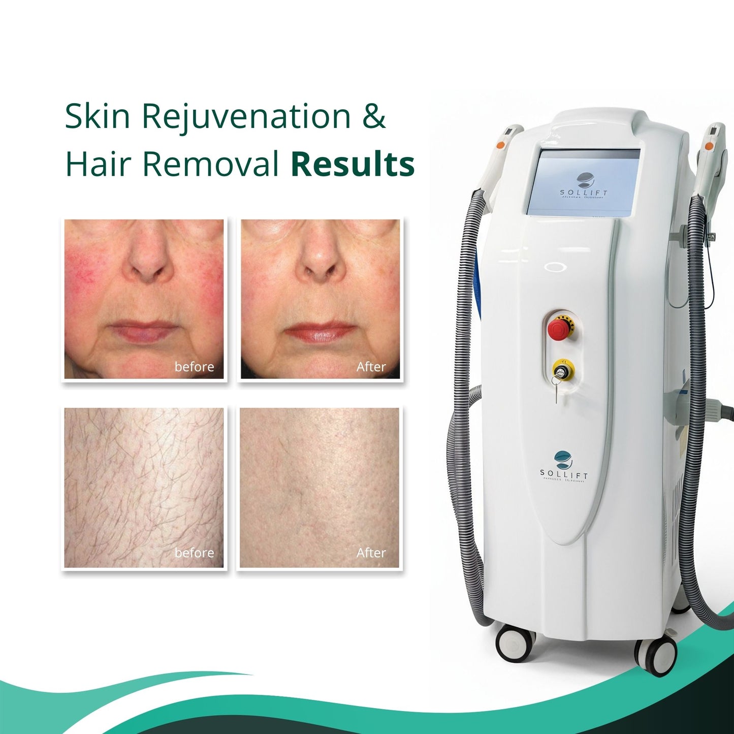 The Medi Next Advanced IPL Hair Removal and Skin Rejuvenation device (FDA-approved)