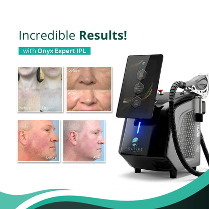 Onyx Expert IPL Hair Removal and Skin Rejuvenation (FDA-Approved & TUV Medical CE-Cleared)