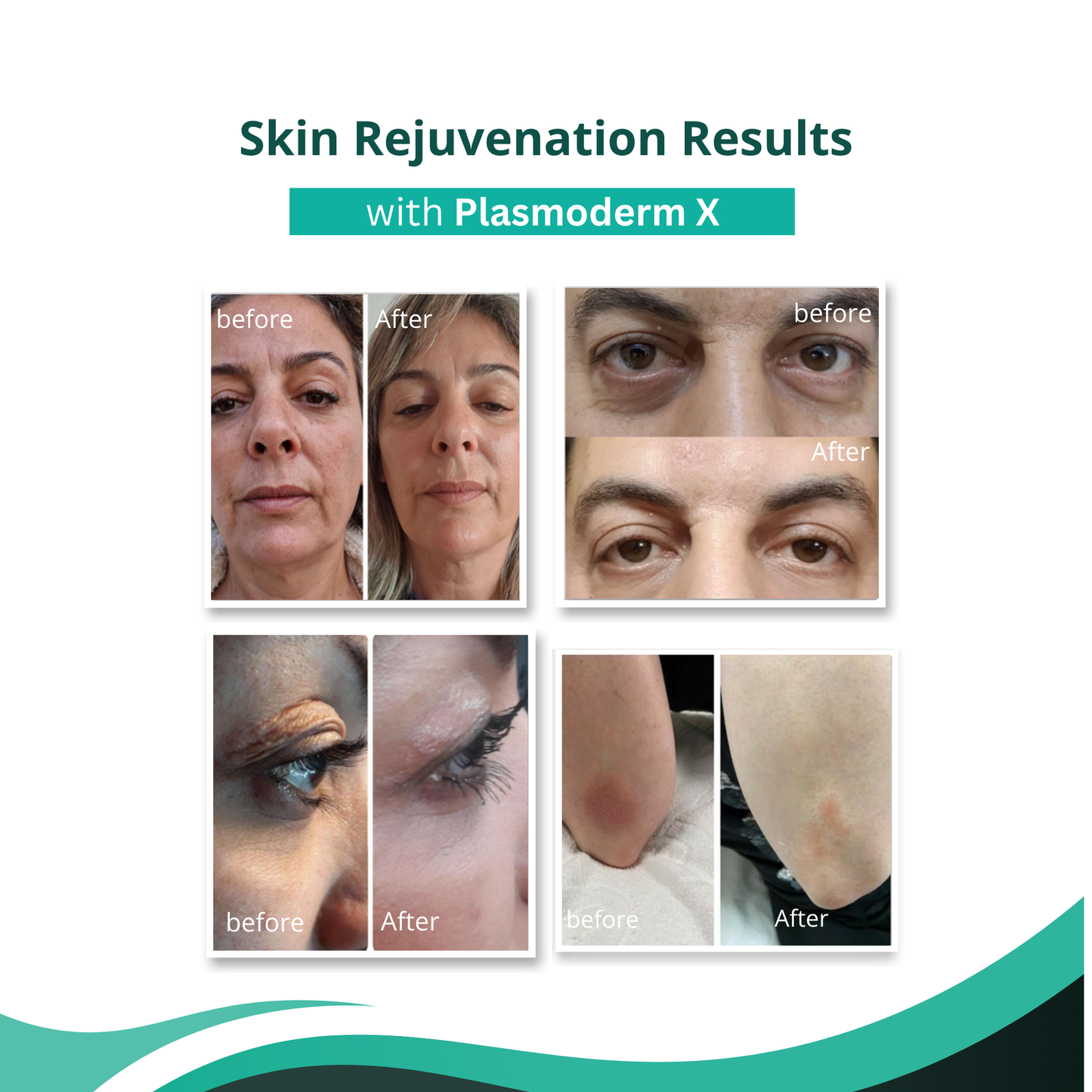 Plasmoderm X Fractional & Cold Plasma System