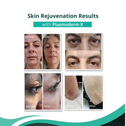 Plasmoderm X Fractional & Cold Plasma System