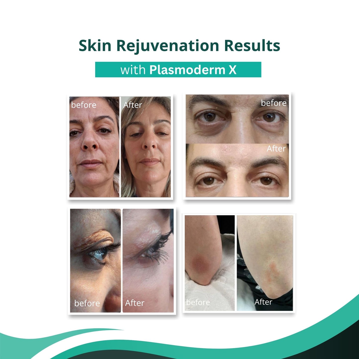 Plasmoderm X Fractional & Cold Plasma System