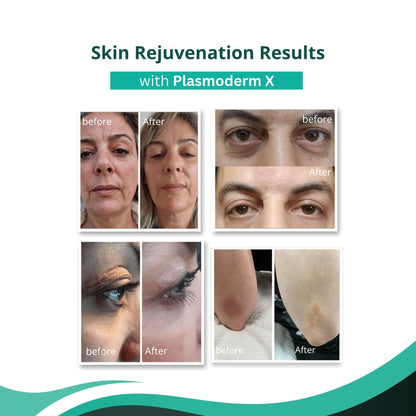 Plasmoderm X Fractional & Cold Plasma System