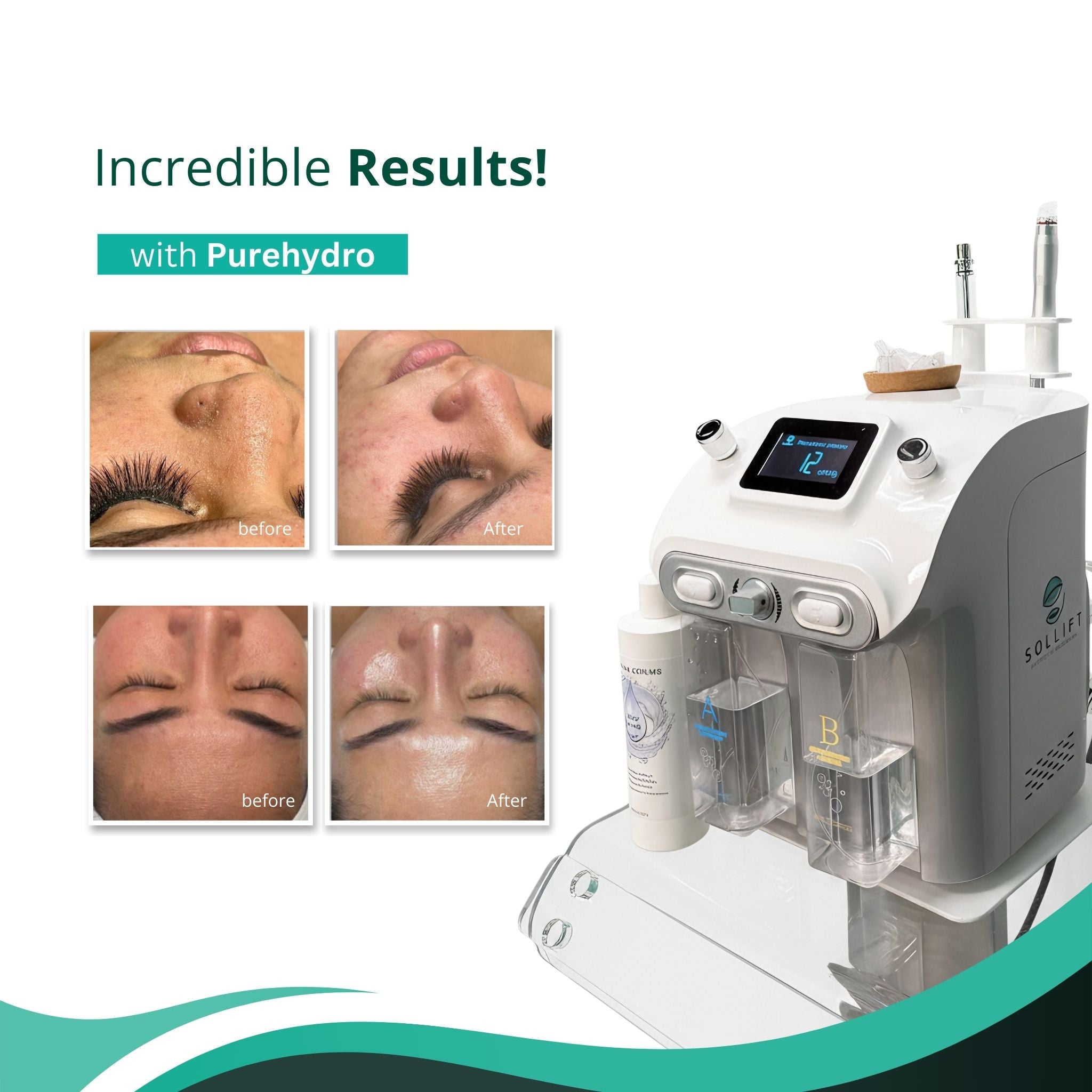 PureHydro - Hydrodermabrasion and Wet Microdermabrasion Machine