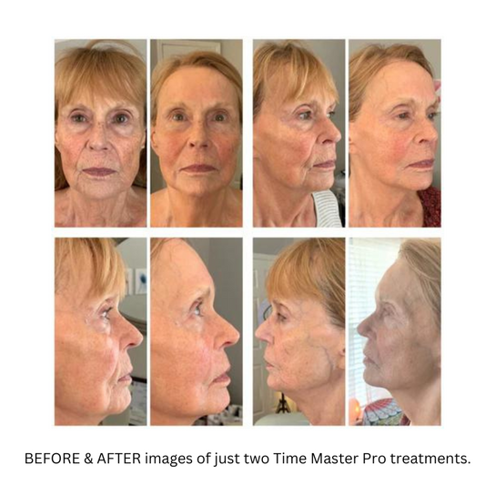 SCULPLLA Time Master Pro Skin Tightening