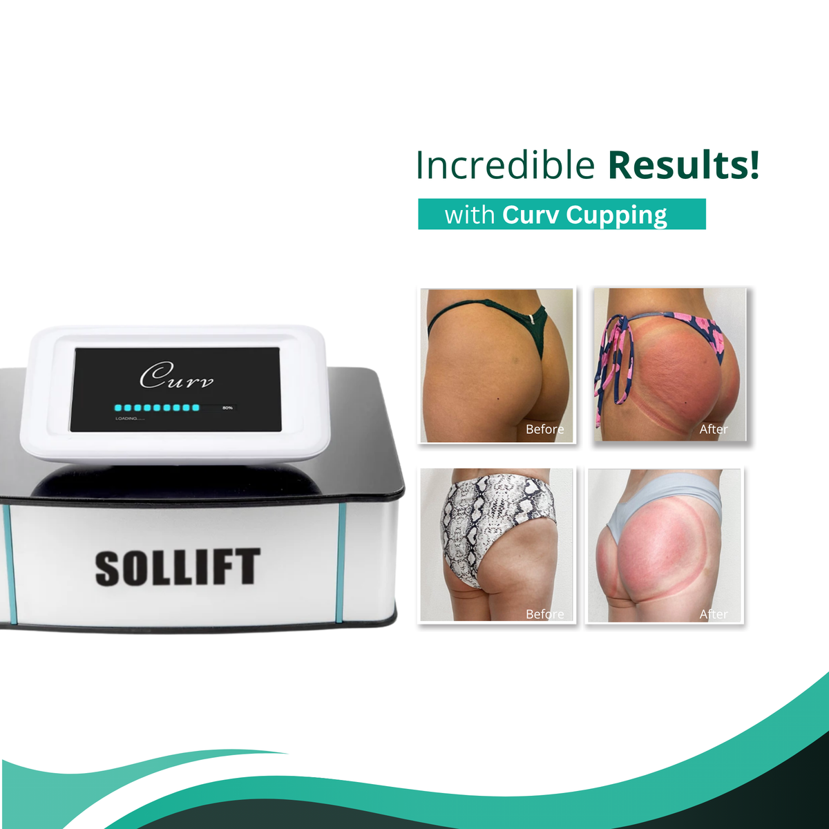 Curv Vacuum and Cupping Therapy
