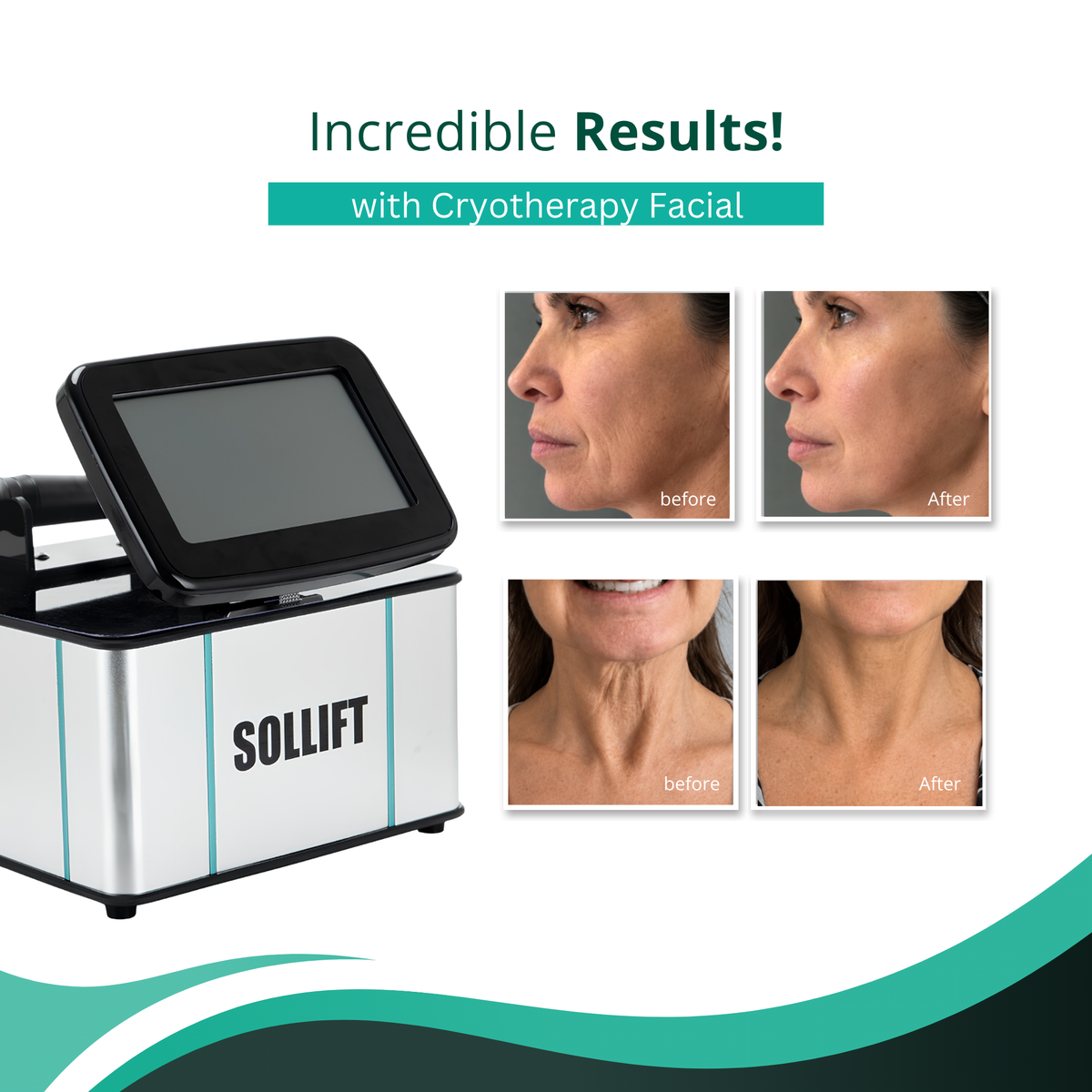 CryoTone Lift Facial Cooling System