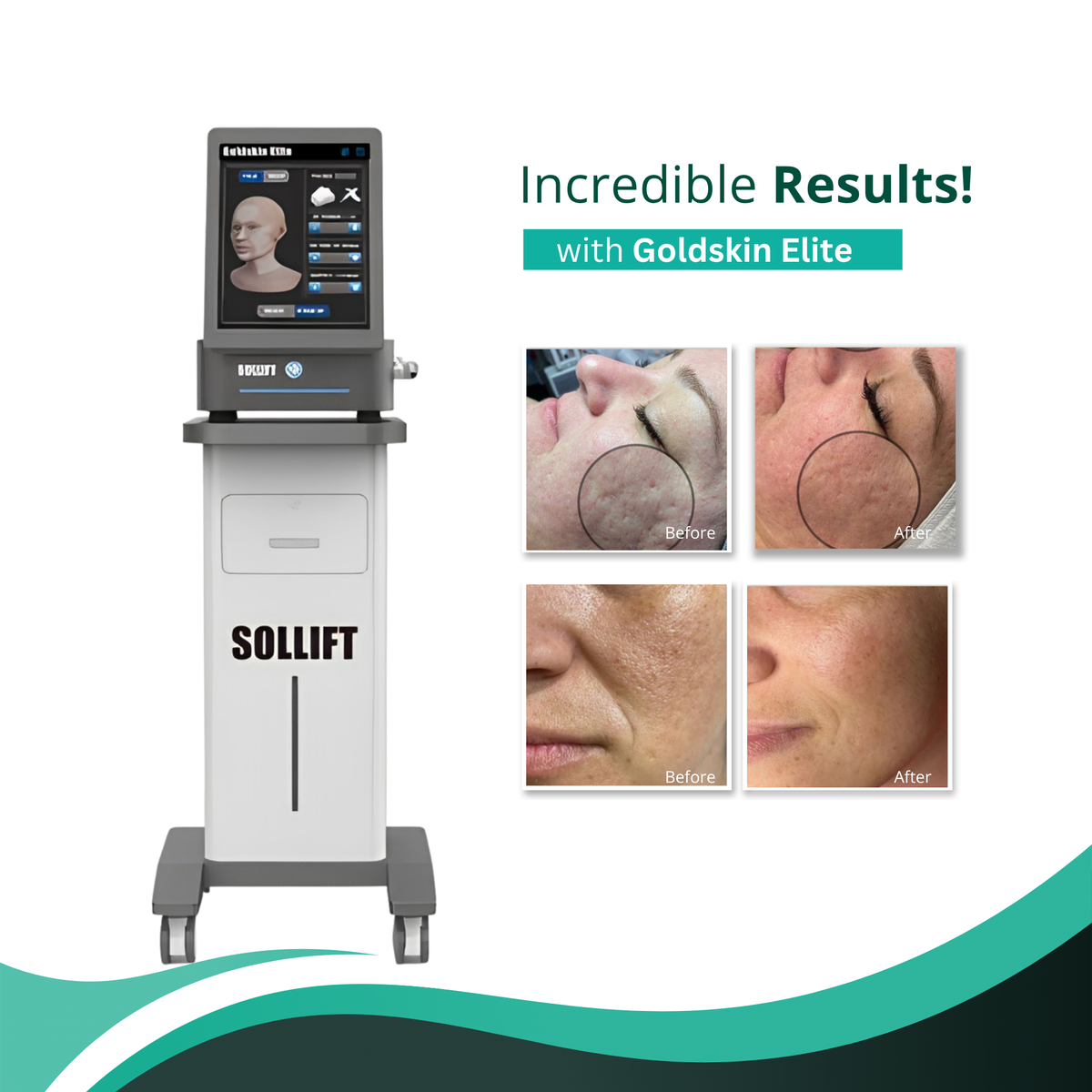 Goldskin Elite Radiofrequency Microneedling & Fractional RF Machine