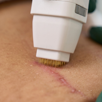 Goldskin Elite Radiofrequency Microneedling & Fractional RF Machine