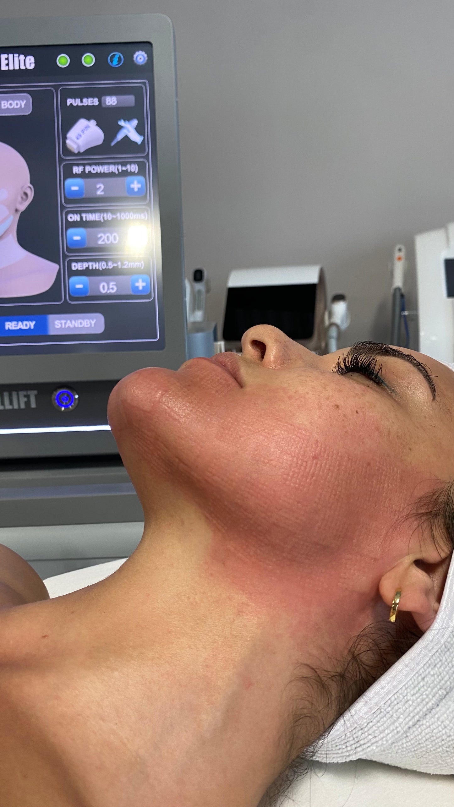 Elite Rf Radiofrequency Microneedling & Fractional RF Machine | Glownar Aesthetics