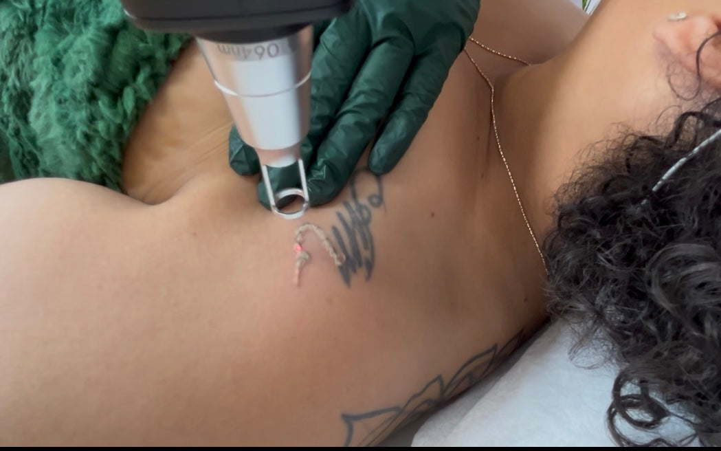 Revita Ink Remaster Tattoo Removal & Skin Rejuvenation Machine