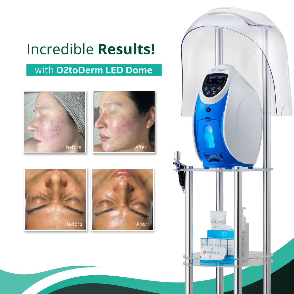 O2toDerm Oxygen + LED Dome (4 Colors)