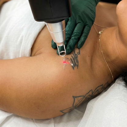 Revita Ink Remaster Tattoo Removal & Skin Rejuvenation Laser