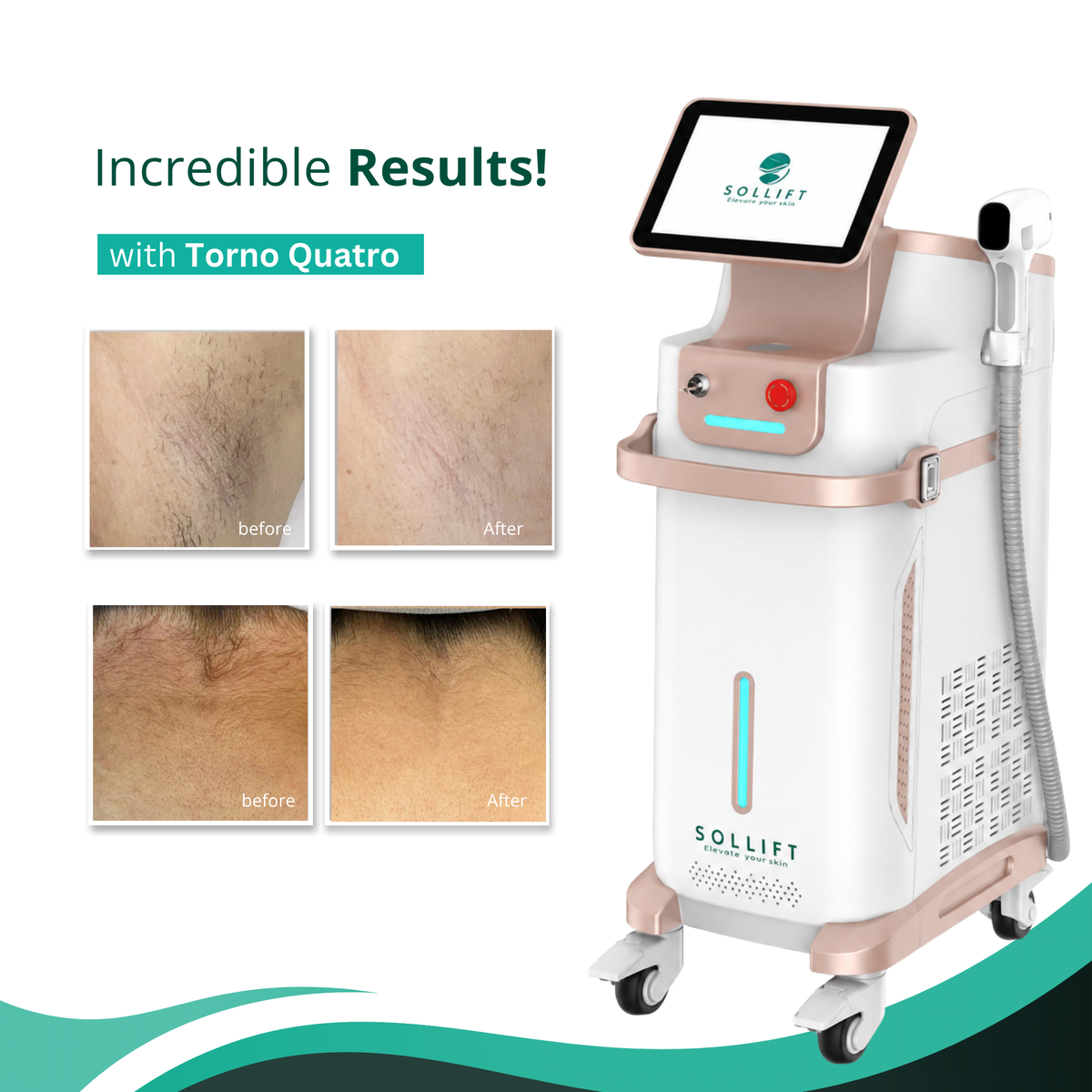 Torno  Quatro Diode Laser Hair Removal with 4 wavelengths