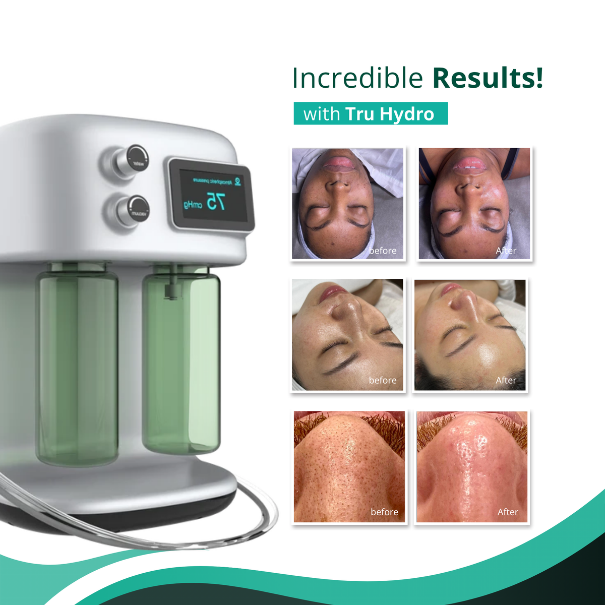 Clearance Tru Hydro 2-in-1 Hydrodermabrasion and Microdermabrasion