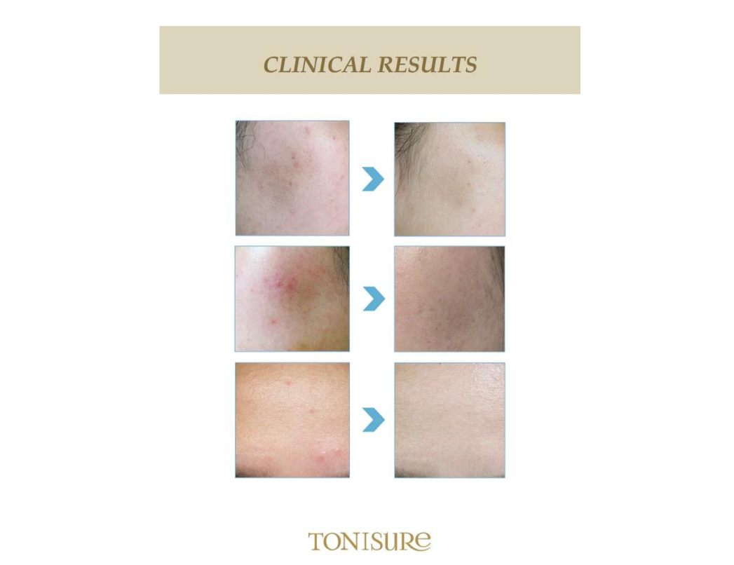 Tonisure Plasma and Galvanic 2-in-1 Skin Care