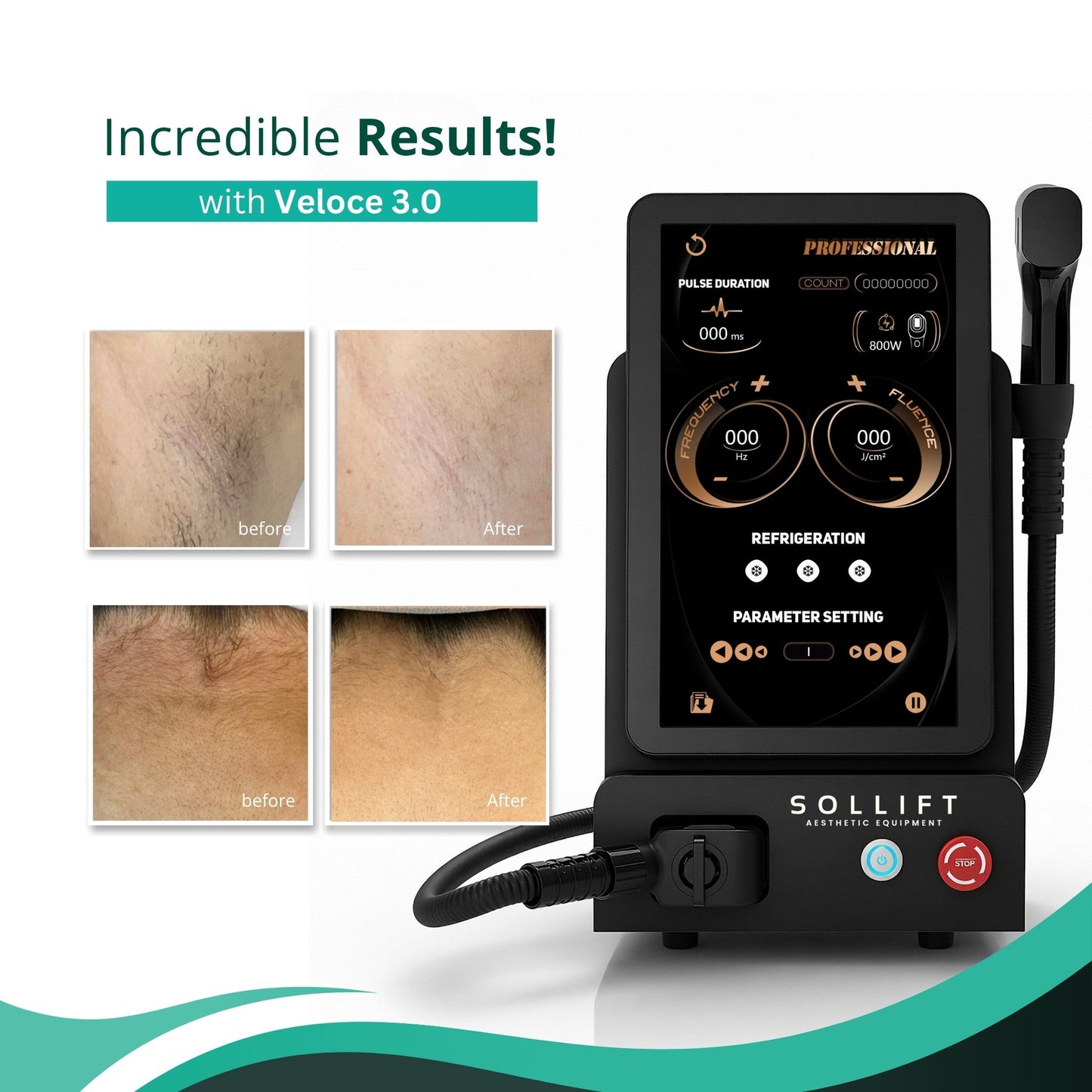 Veloce 808 Diode 3.0 Laser Hair Removal