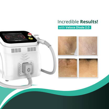 Clearance Veloce Diode 2.0 Laser Hair Removal