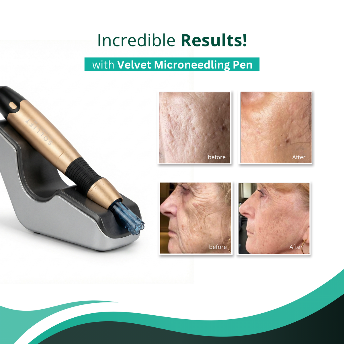 Velvet Microneedling Pen (FDA-Cleared medical grade - CE and Health Canada Approved)