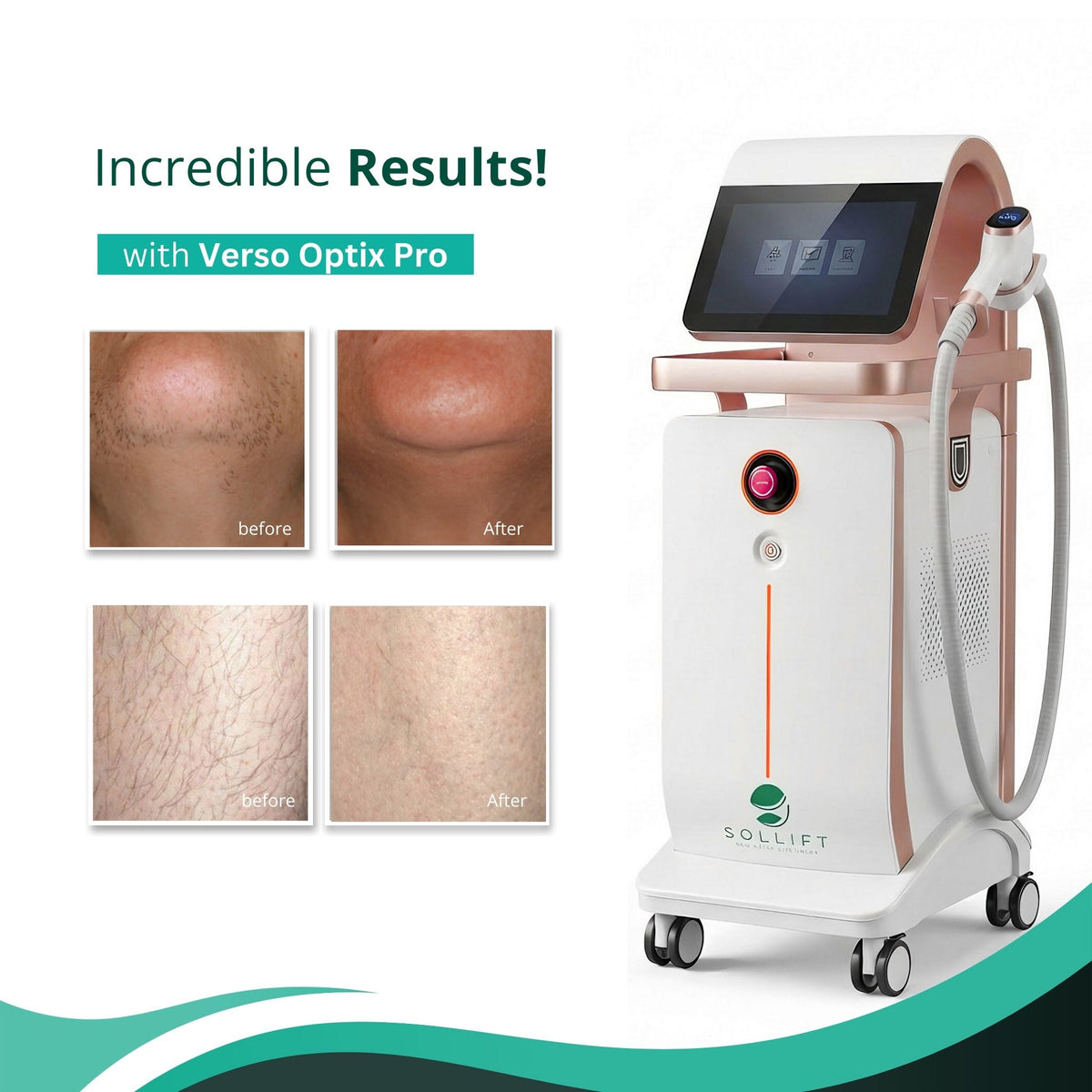 Clearance Verso Optix Pro Diode Laser Hair Removal with Interchangeable Spot Size