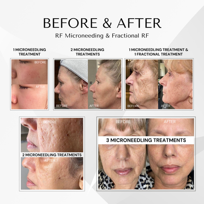 Goldskin Elite Radiofrequency Microneedling & Fractional RF