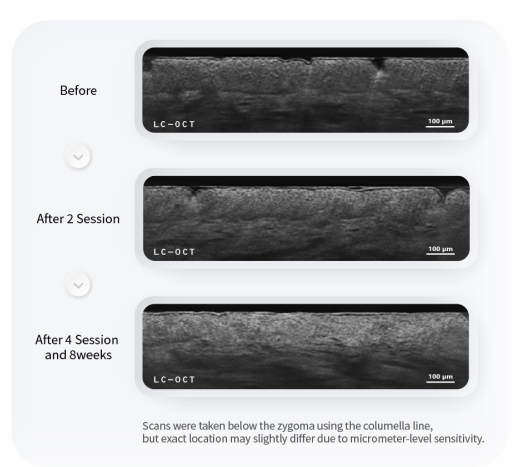 PURI PDRN Professional Skin Rejuvenation System