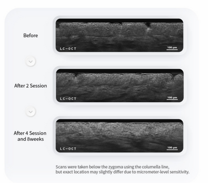 PURI PDRN Professional Skin Rejuvenation System