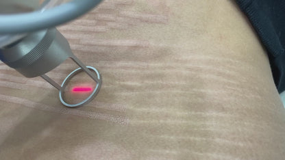 Silk Lotus CO2 Laser (FDA-cleared)