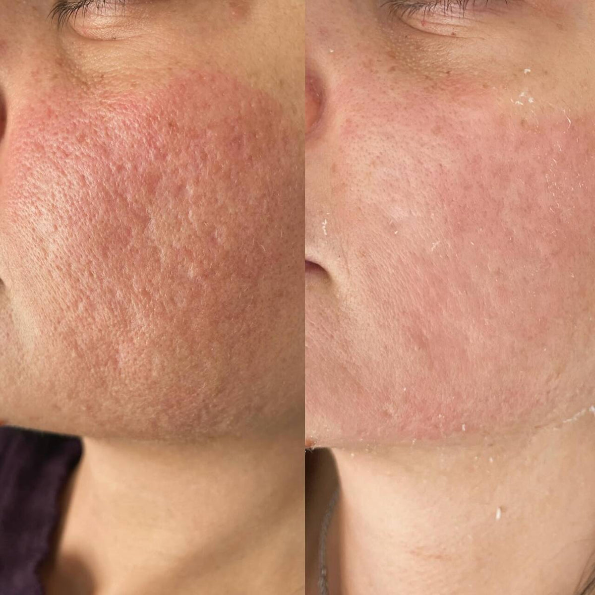 Silk Lotus CO2 Laser (FDA-cleared)