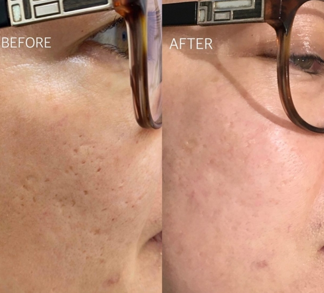 Silk Lotus CO2 Laser (FDA-cleared)
