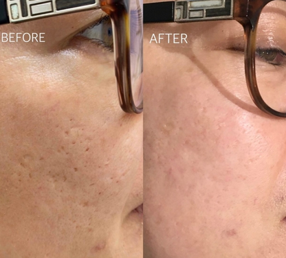 Silk Lotus CO2 Laser (FDA-cleared)