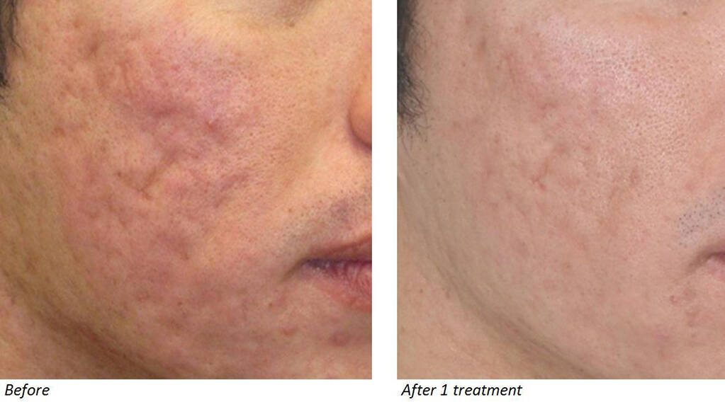 Silk Lotus CO2 Laser (FDA-cleared)