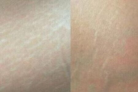 Silk Lotus CO2 Laser (FDA-cleared)